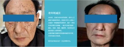 永球适温消融技术创始人 ——宁永球院长