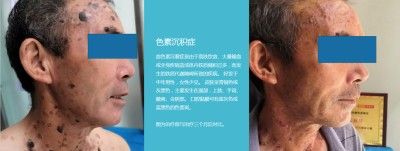 永球适温消融技术创始人 ——宁永球院长