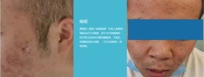 永球适温消融技术创始人 ——宁永球院长