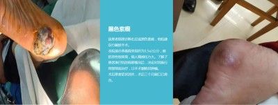 永球适温消融技术创始人 ——宁永球院长