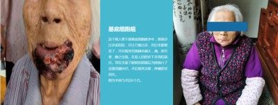 永球适温消融技术创始人 ——宁永球院长