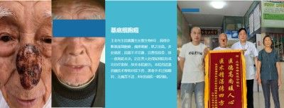 永球适温消融技术创始人 ——宁永球院长