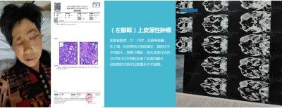 永球适温消融技术创始人 ——宁永球院长