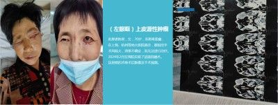 永球适温消融技术创始人 ——宁永球院长