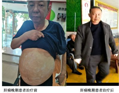 治疗各种癌症无效不收费广西百色杨忠雅医师