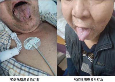 治疗各种癌症无效不收费广西百色杨忠雅医师