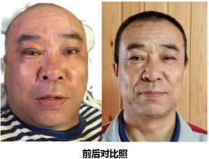 卓越成果写传奇 悬壶济世誉华夏  中医艾灸大烤——成铁